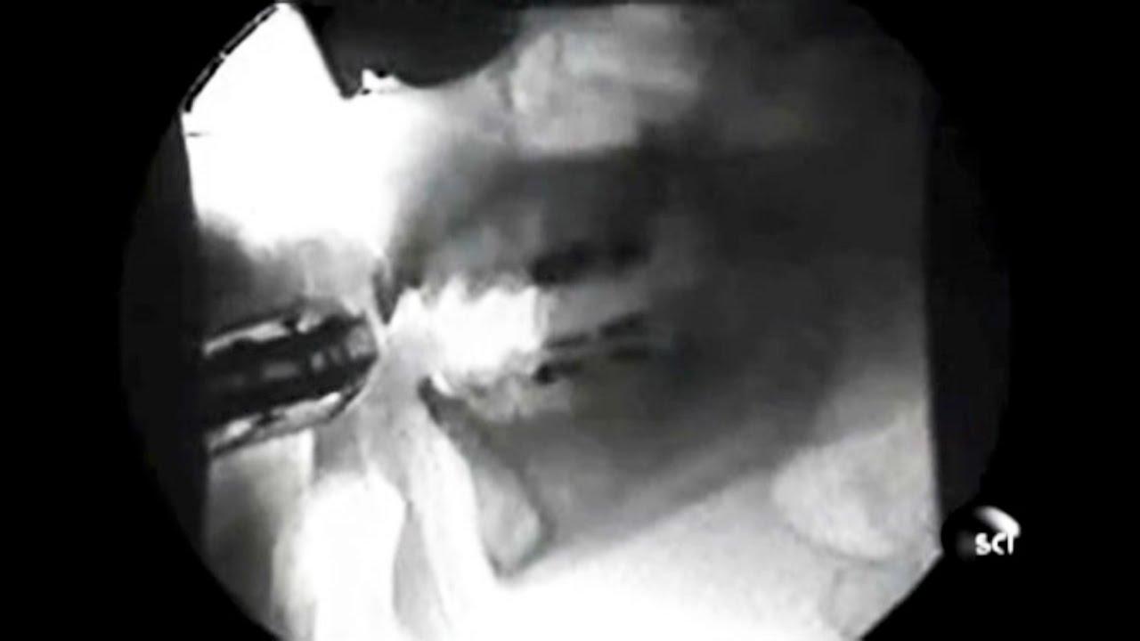 Deepthroat x ray